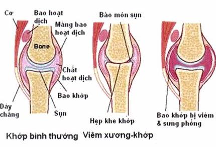 Bệnh thấp khớp: Điều trị bằng những cây thuốc quanh ta